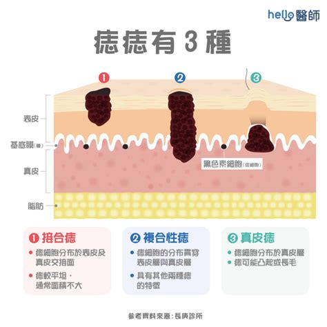 身體長痣的原因|皮膚長「紅痣」會怎樣？跟黑痣有何不同？會是皮膚癌。